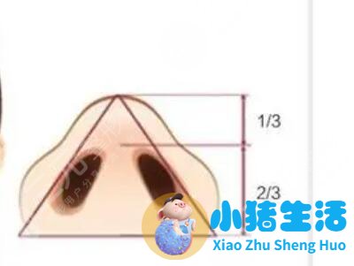 鼻翼过宽