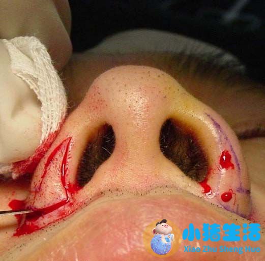 鼻孔整形真实案例