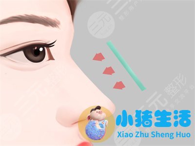 鼻孔整形真实案例