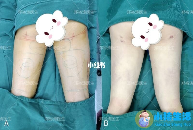 抽脂双下已恢复期护理