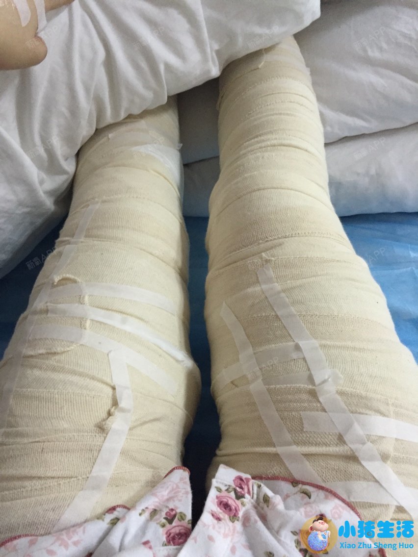 抽脂双下已恢复期护理