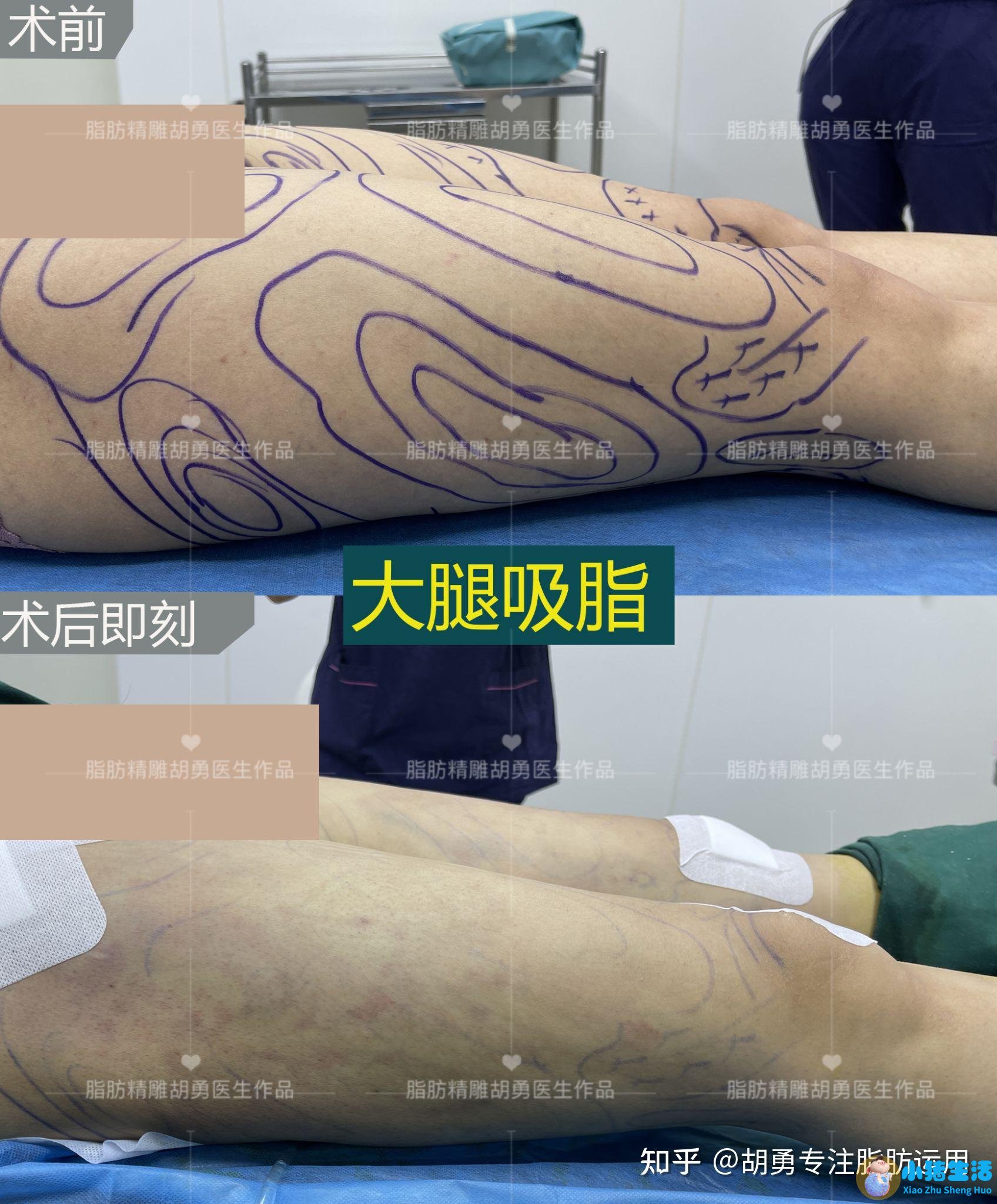 抽脂双下已恢复期护理