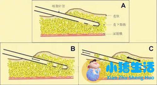 抽脂双下已恢复期护理