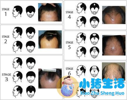 毛囊炎脱发头发长得慢