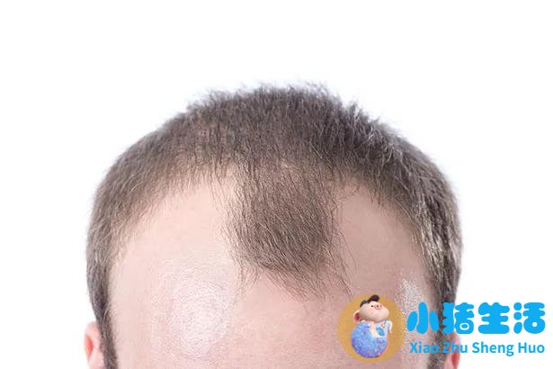 毛囊炎脱发头发长得慢