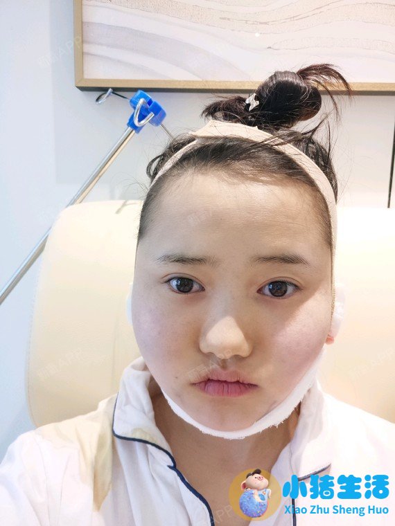 抽脂双下已恢复期护理