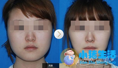 面部吸脂前后对比案例