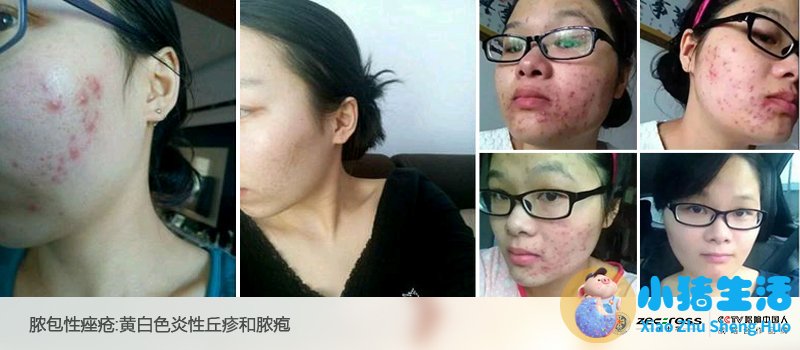 韩国护肝敏有副作用吗