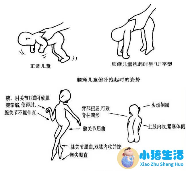 新生儿脑瘫可以治好吗
