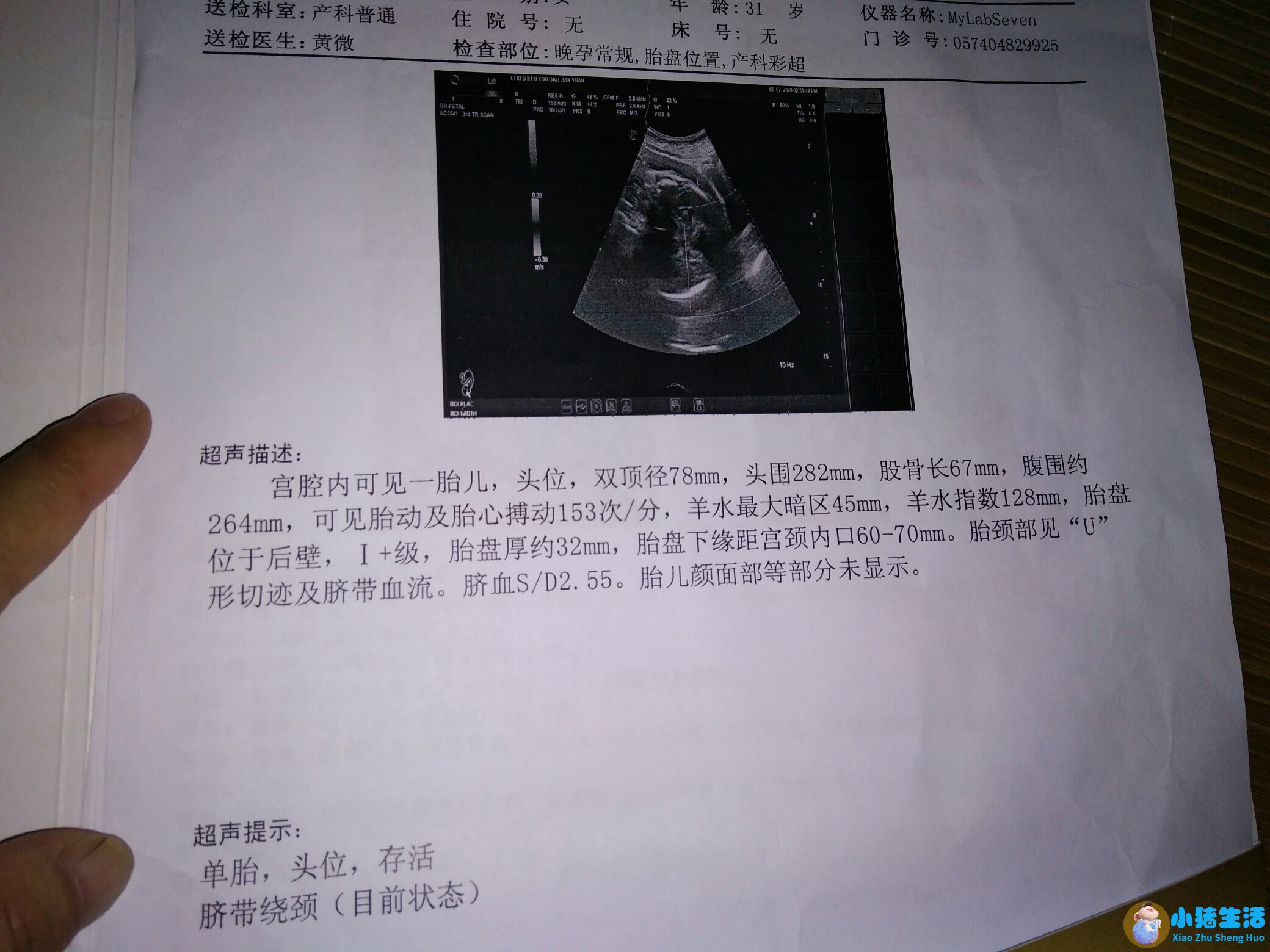 孕晚期胎儿腿长是女孩