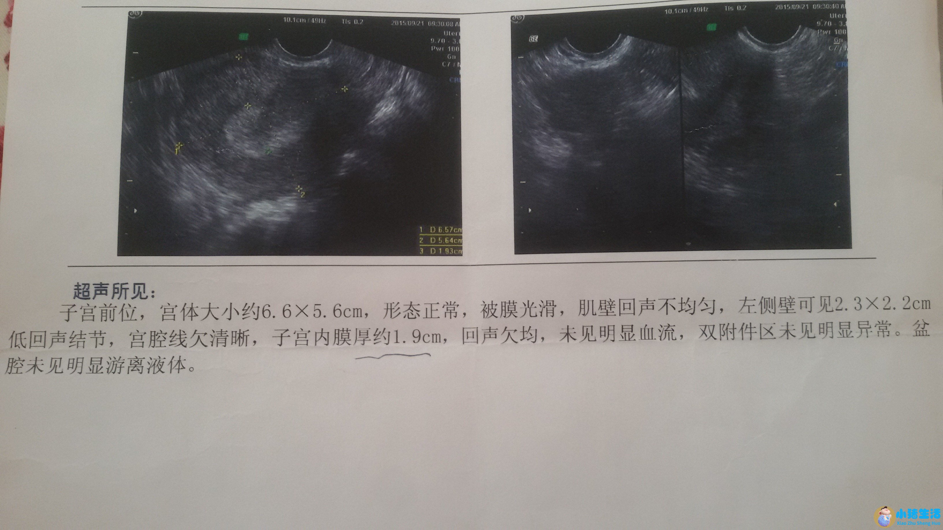 月经量少对怀孕有影响吗