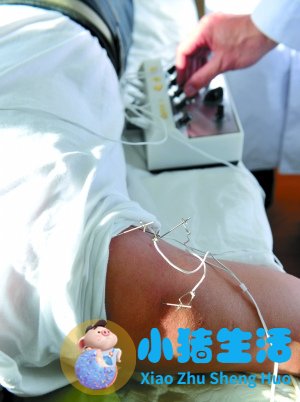 电针。医生要专门学习两到三年才能开始针灸治疗。（资料图）