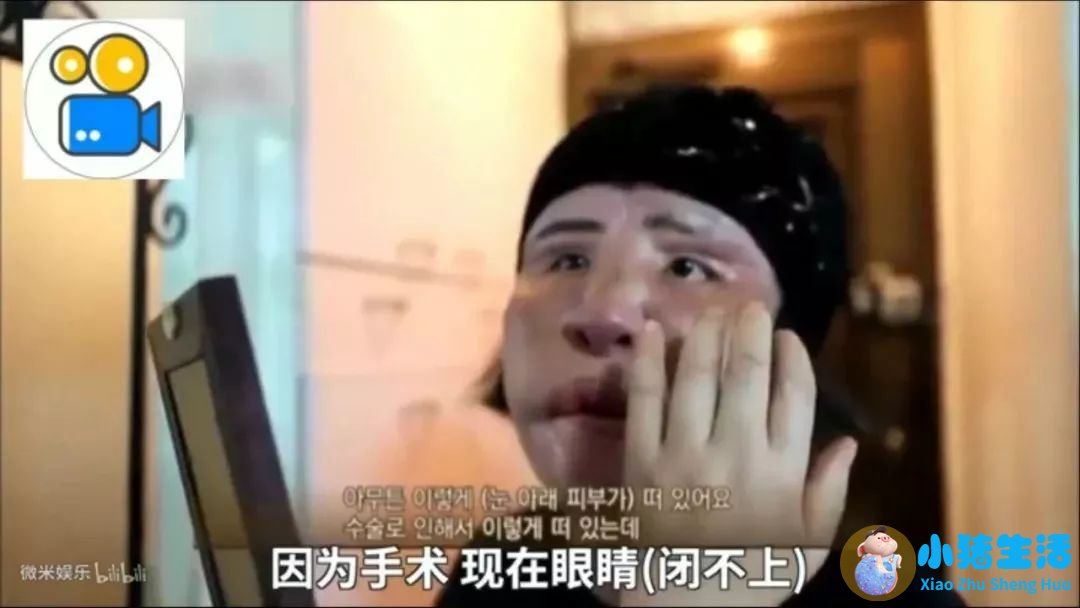济南海峡整形失败案例