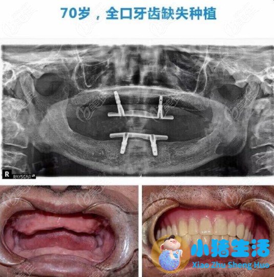 现在头发种植的价格