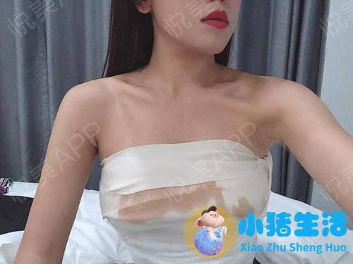 胸部整形案例