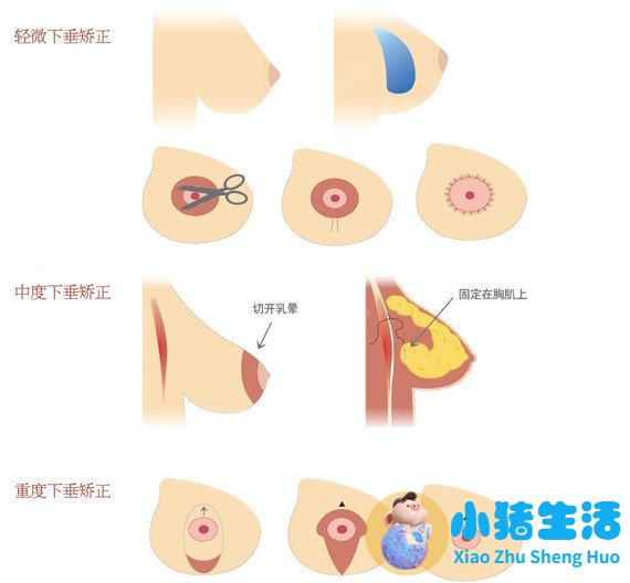胸部整形案例