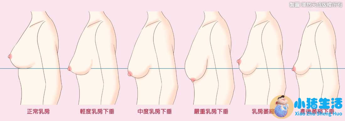 胸部整形案例