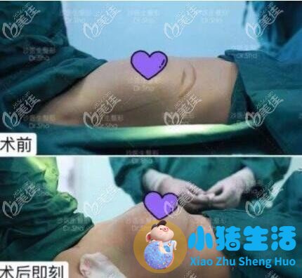 胸部整形案例