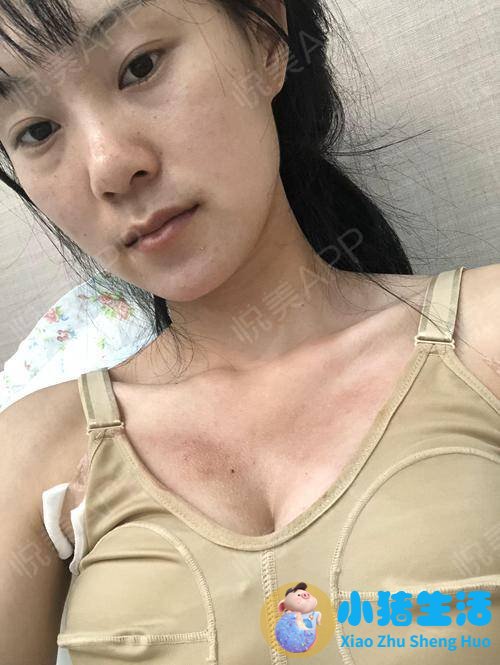 胸部整形案例