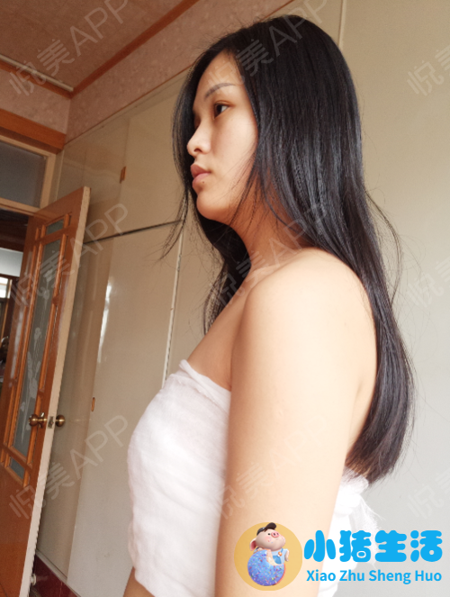 胸部整形案例