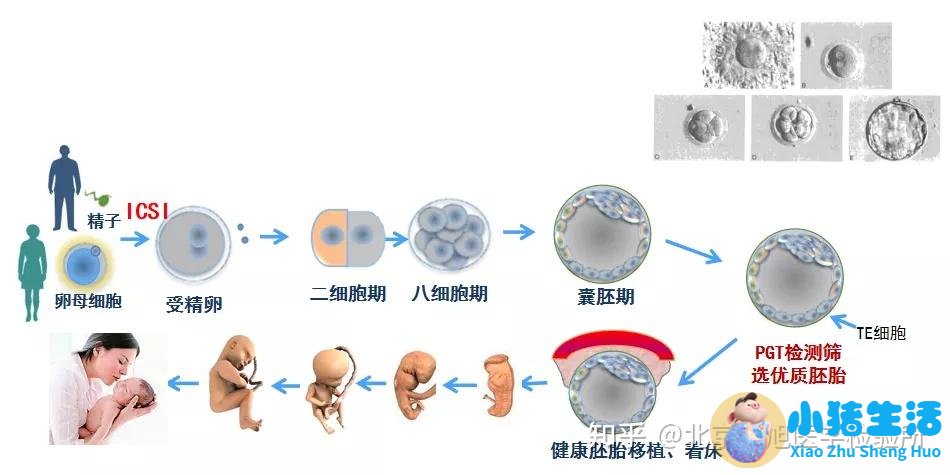 试管婴儿会有无脑儿吗