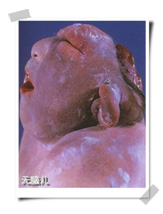 试管婴儿会有无脑儿吗