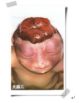 试管婴儿会有无脑儿吗