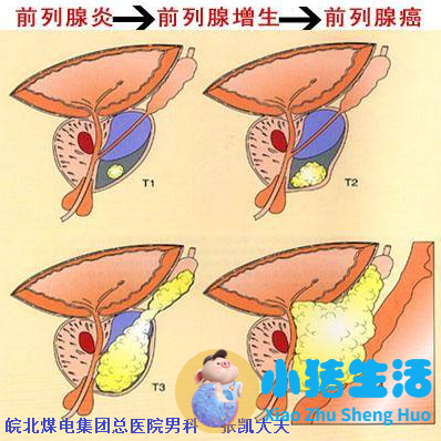 前列腺炎与性功能障碍:中青年男性保健必读
