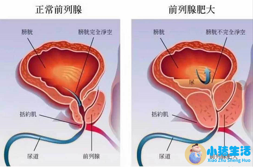前列腺炎与性功能障碍:中青年男性保健必读