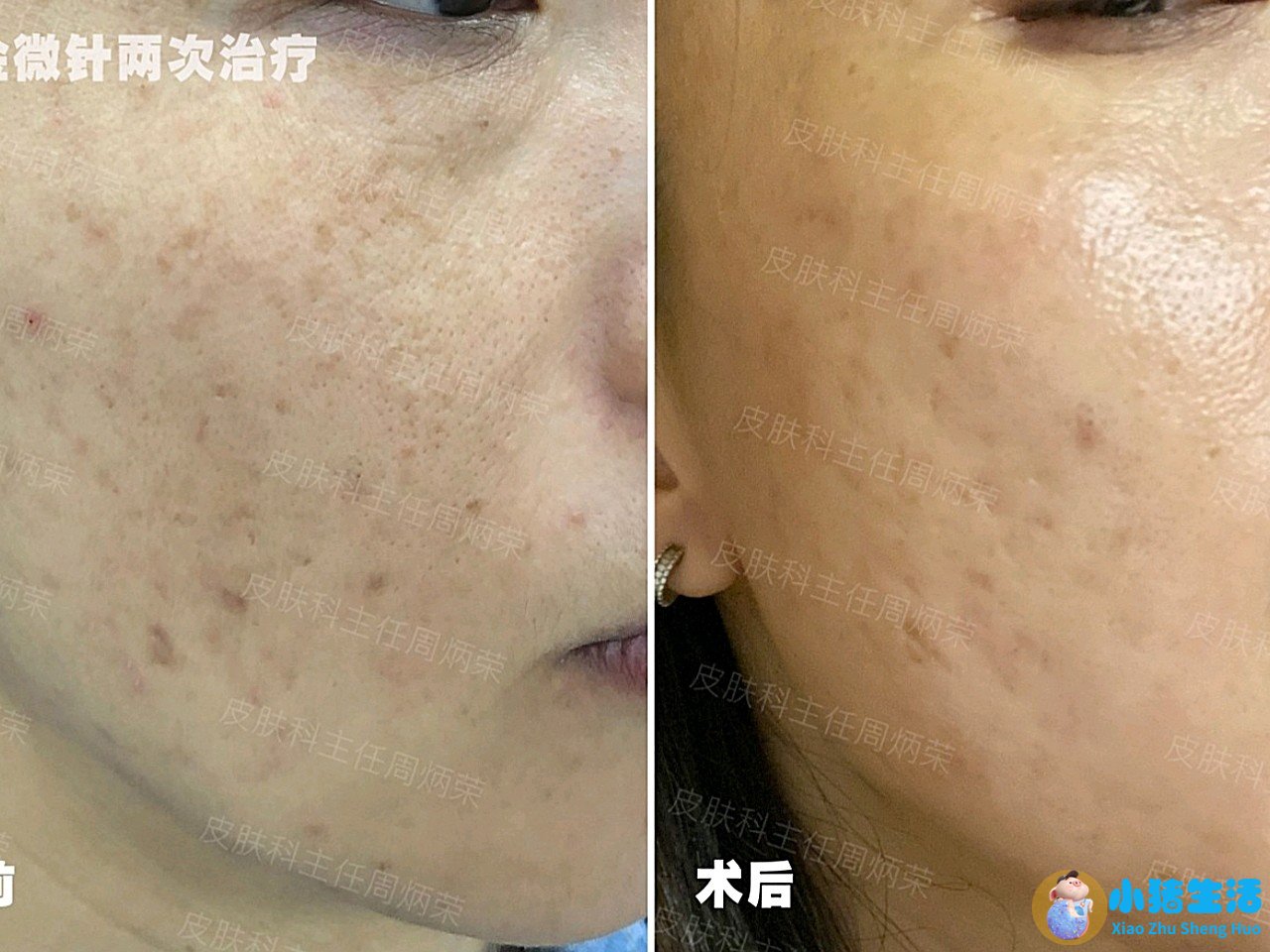黄金比例微创改脸术的成功案例