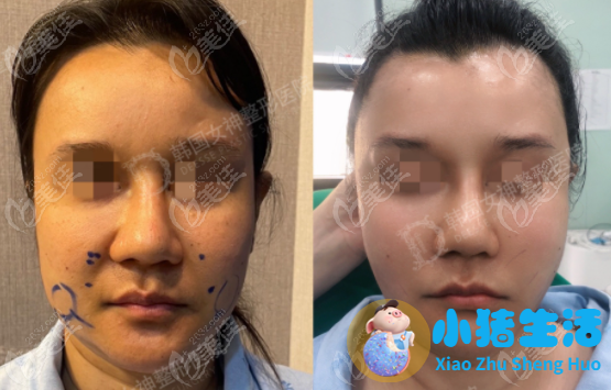 脸部整形案例