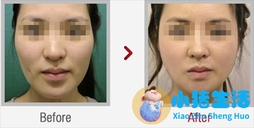 脸部整形案例