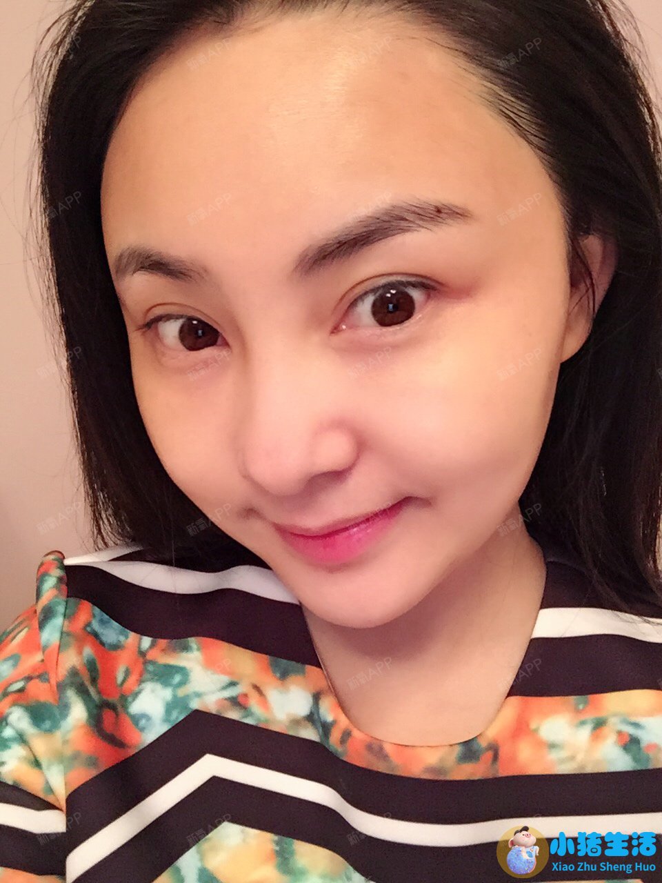 佳美整形失败案例