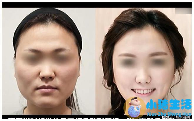 佳美整形失败案例