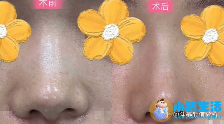打玻尿酸效果能永久吗