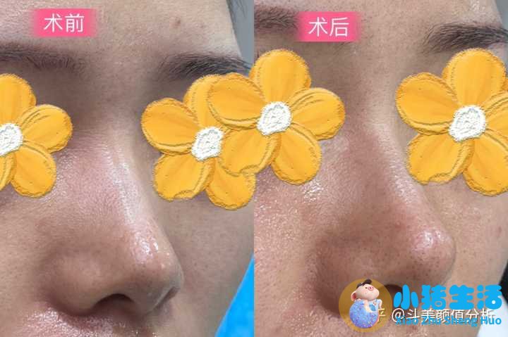 打玻尿酸效果能永久吗