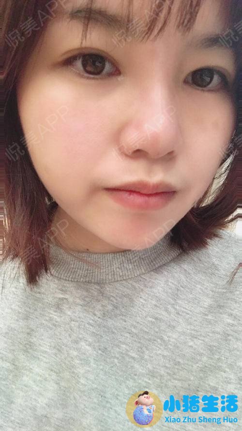 打玻尿酸效果能永久吗