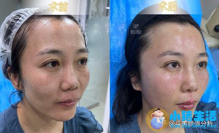打玻尿酸效果能永久吗