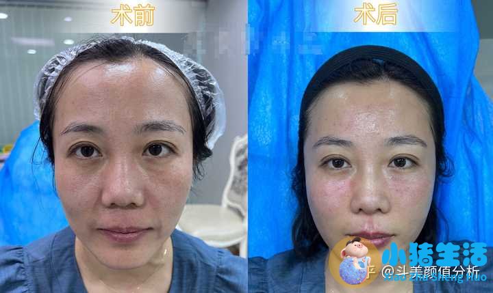 打玻尿酸效果能永久吗