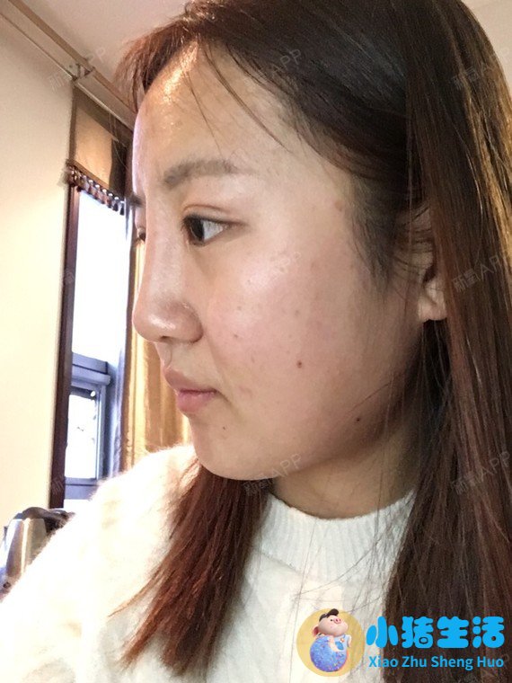 打玻尿酸效果能永久吗