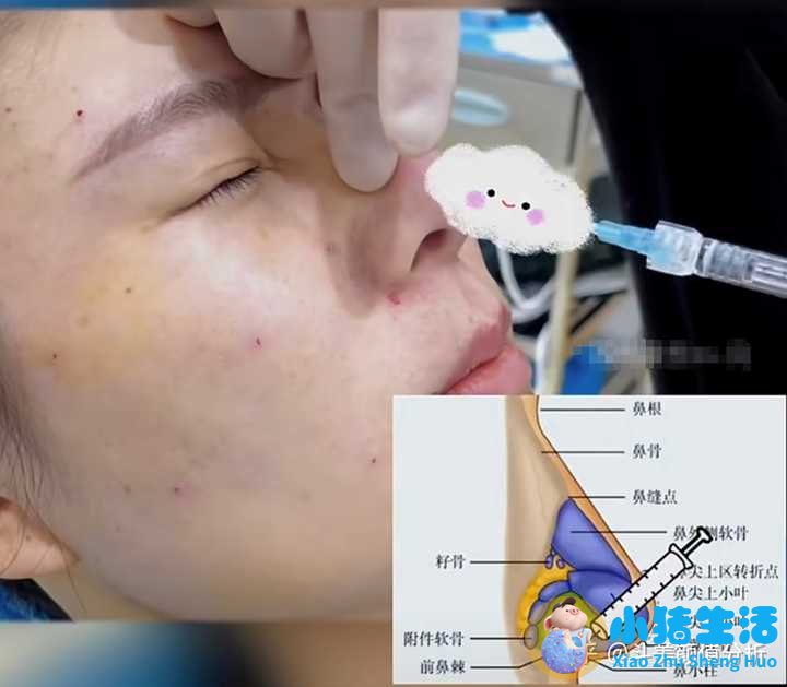 打玻尿酸效果能永久吗