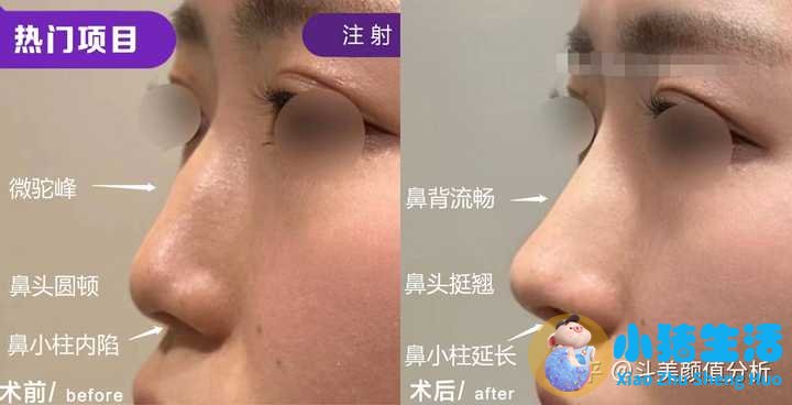 打玻尿酸效果能永久吗