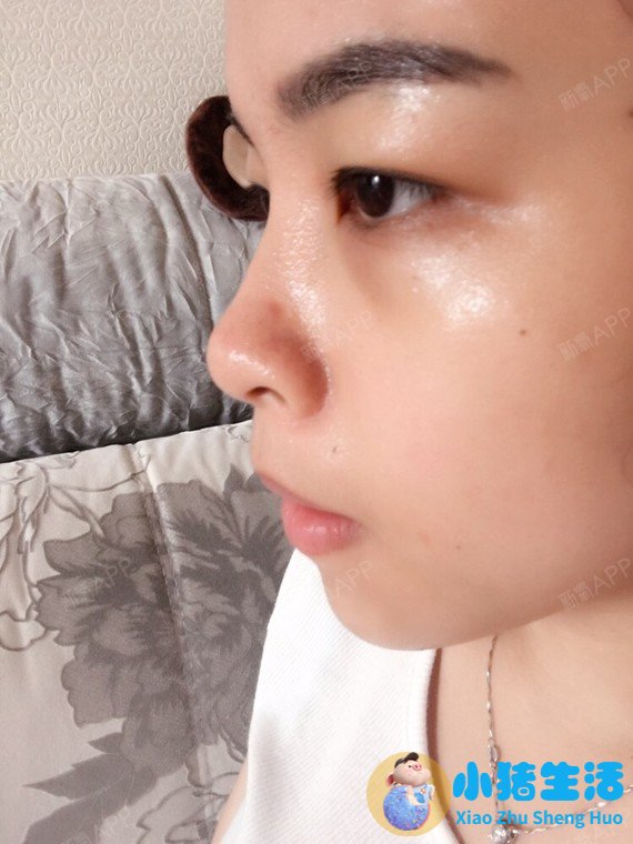 打玻尿酸效果能永久吗
