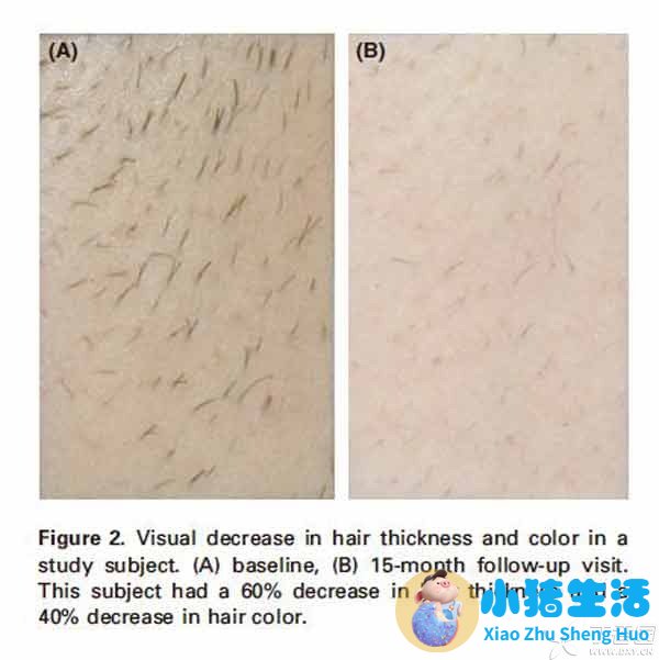 【插图】激光脱毛-脱毛前后-600.jpg