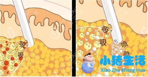 局部吸脂