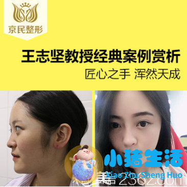 李琳鼻整形案例