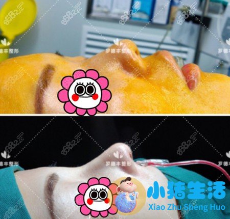 李琳鼻整形案例