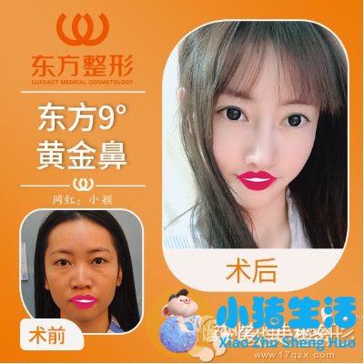 李琳鼻整形案例