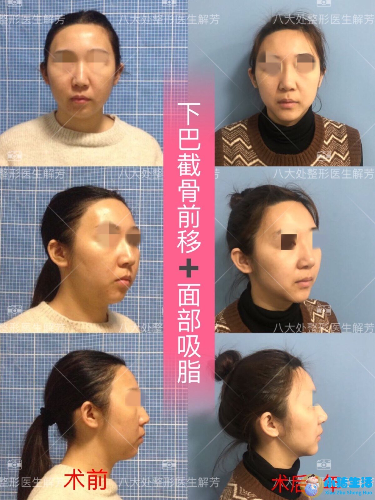 面部吸脂1年效果怎么样