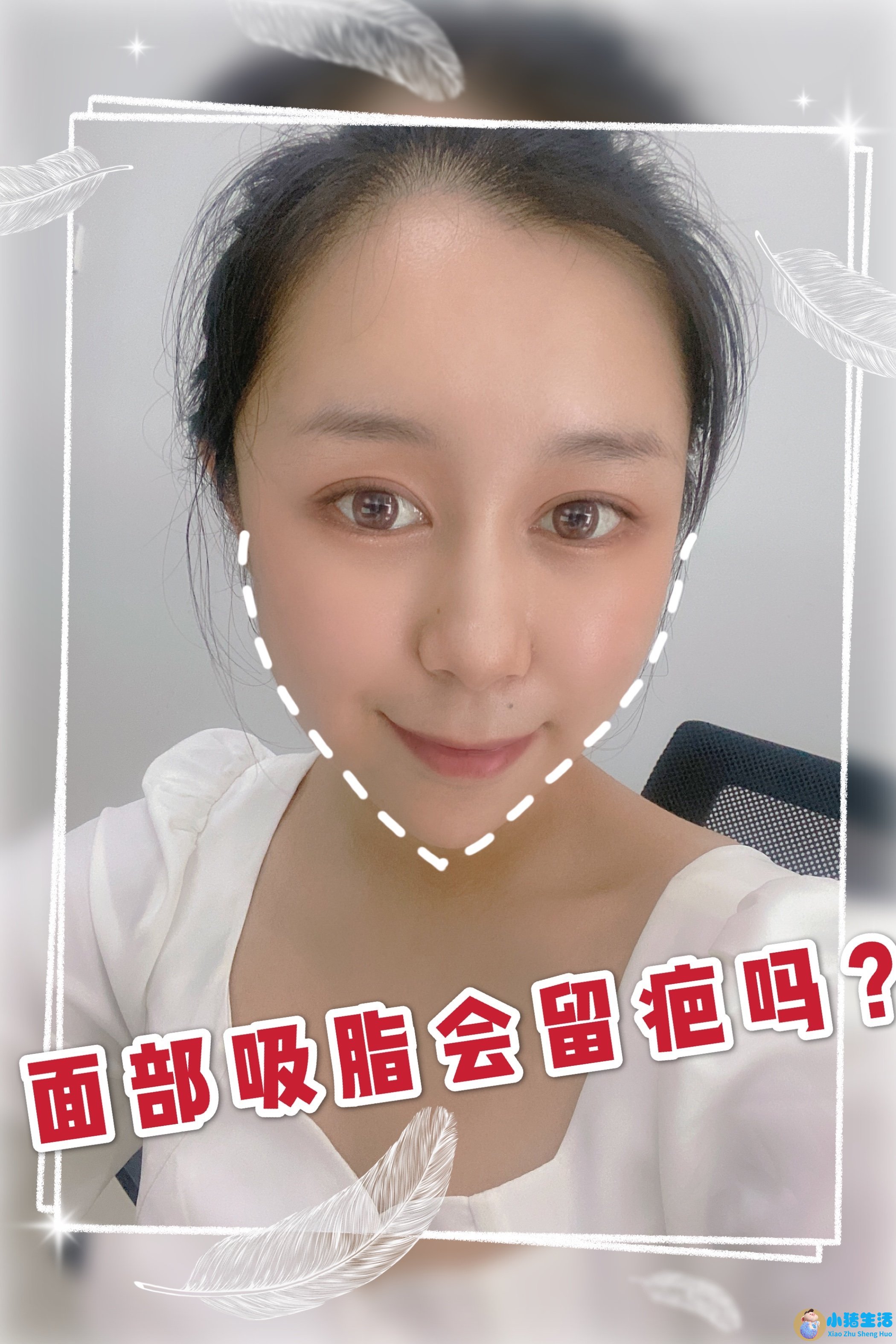 面部吸脂1年效果怎么样
